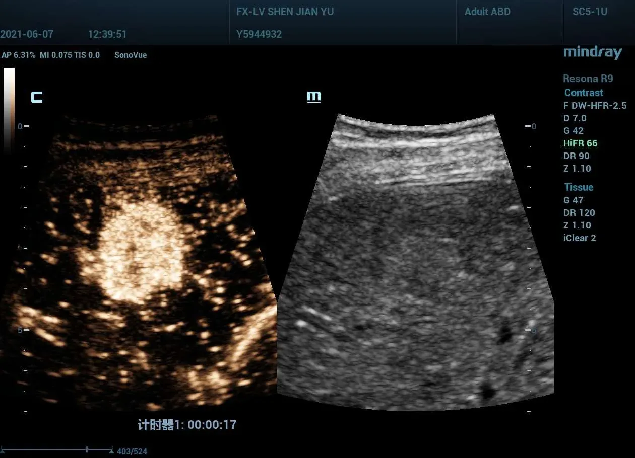 Contrast Imaging (UWN+)