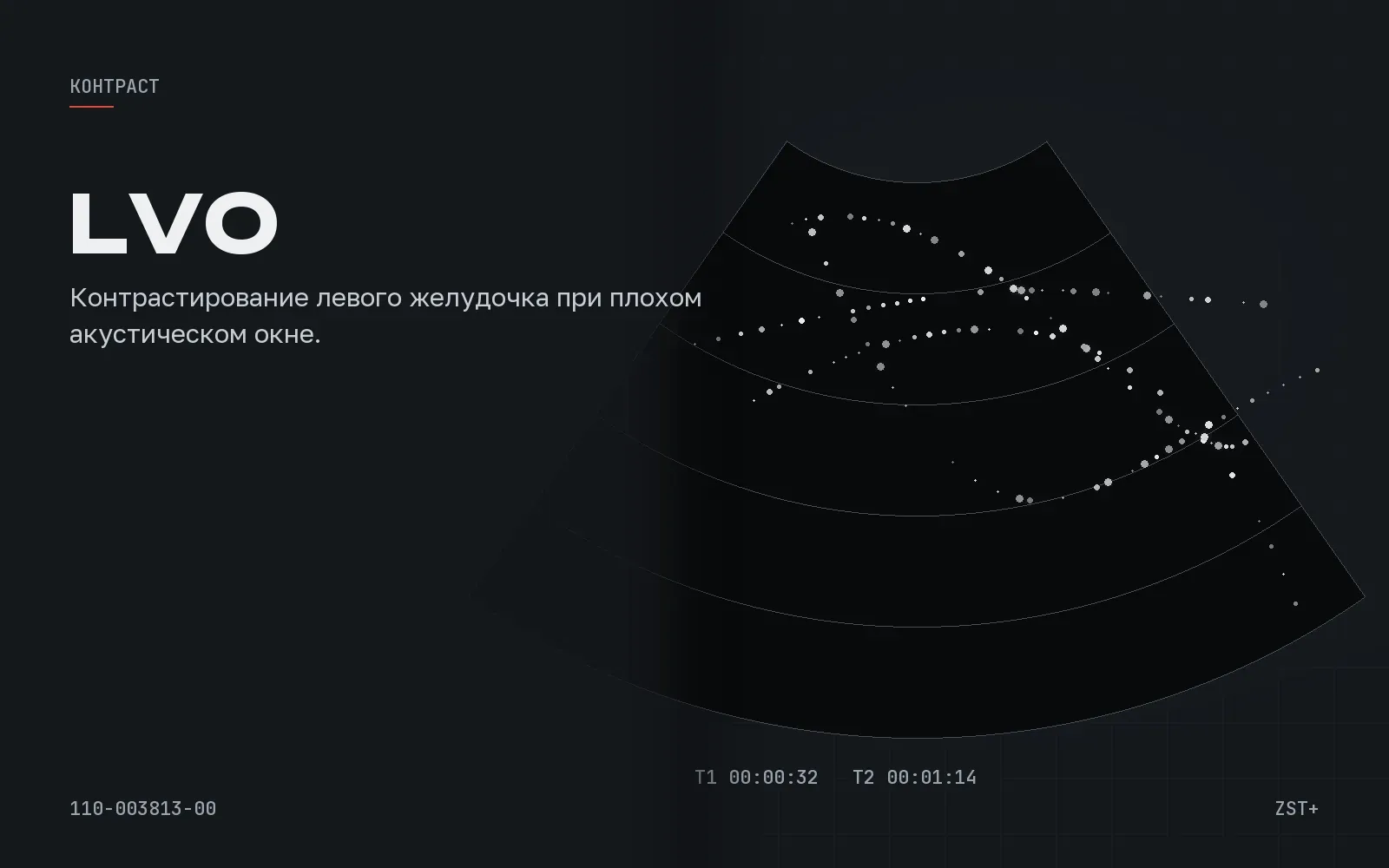 УЗИ сердца с контрастом: как делают и зачем нужны режимы LVO и VLMI