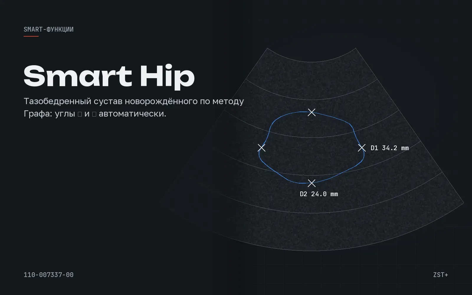 Smart Hip